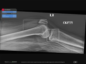 RBfracture screenshot - Lipohemarthrosis and fracture 2