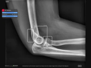 Radiobotics case study - Elbow joint effusion - RBfracture screenshot 2