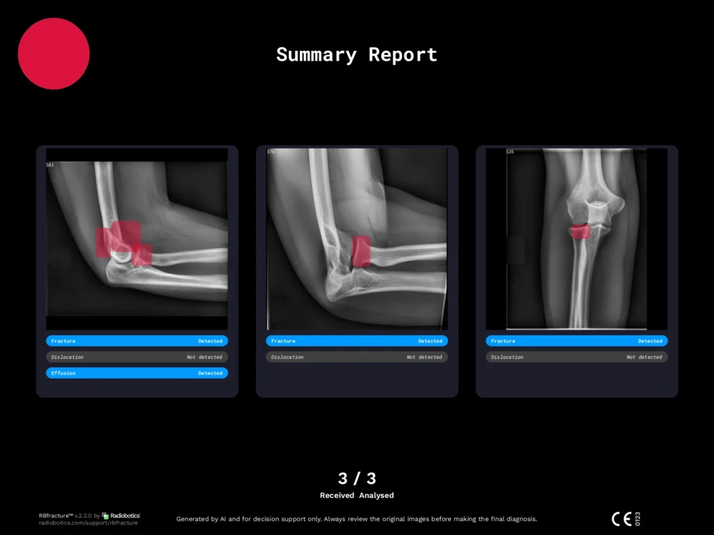 Radiobotics case study - Elbow joint effusion - RBfracture screenshot 3