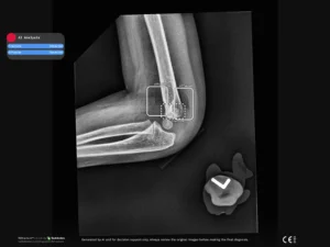 Radiobotics case study - Elbow joint effusion paediatric - RBfracture screenshot 1