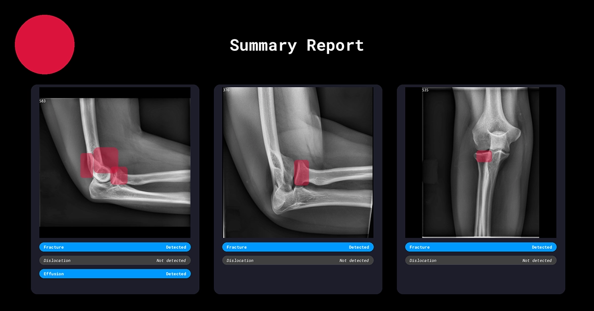 Radiobotics case study - Joint elbow effusions