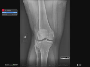 Radiobotics case study - Lipohemarthrosis - RBfracture screenshot 2