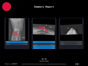 Radiobotics case study - Lipohemarthrosis - RBfracture screenshot 3