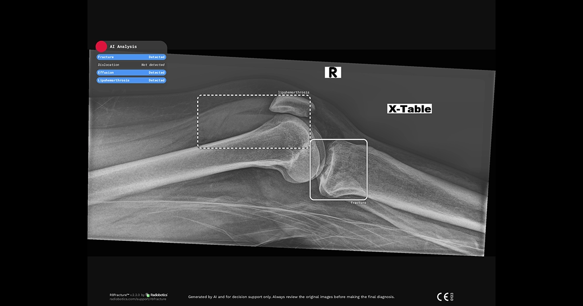 Radiobotics case study - Lipohemarthrosis