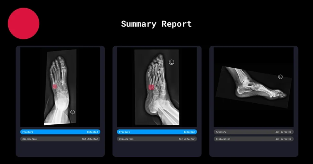 Radiobotics case study - Jones fracture