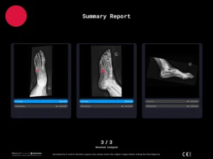 Radiobotics case study - Jones fracture - RBfracture screenshot
