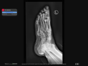 Radiobotics case study - Jones fracture - RBfracture screenshot