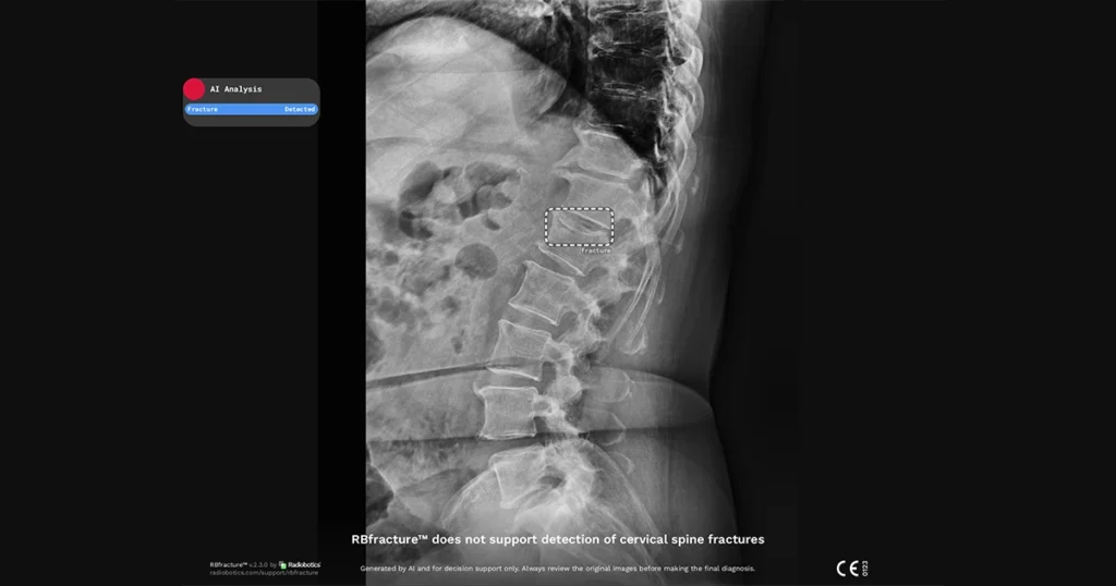 Radiobotics press release - Radiobotics expands RBfracture capabilities for thoracic and lumbar spine fracture detection