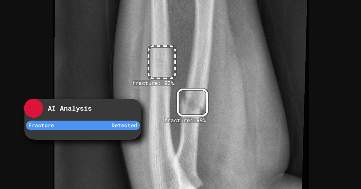 Experience RBfracture's confidence with the our confidence scoring