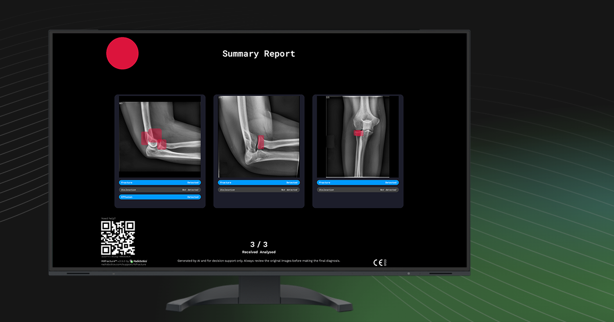 Now live in RBfracture version 2.5- Submit feedback instantly via QR code