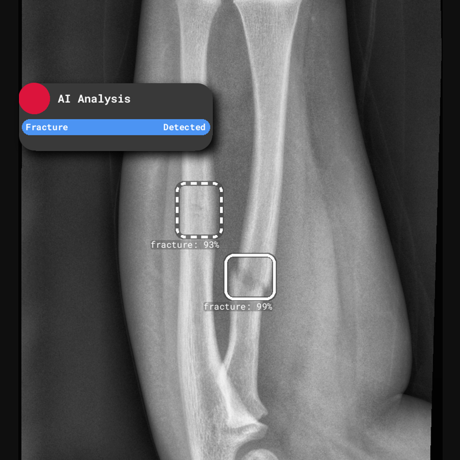 RBfracture confidence scoring - RBfracture output 2