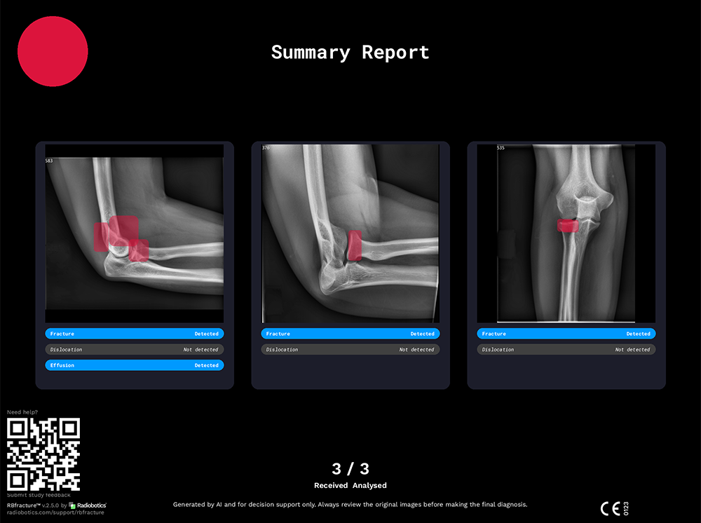 Submit feedback instantly via QR code - RBfracture Summary Report example